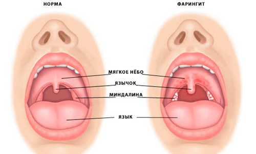 Признаки фарингита Признаки фарингита
