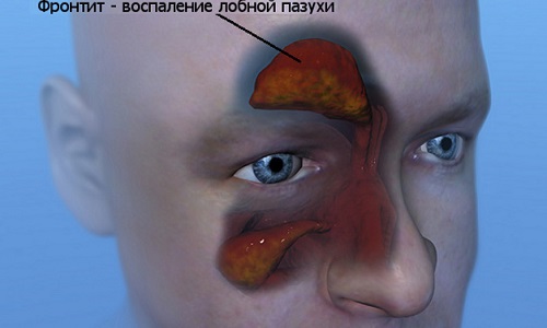 Схема фронтита Схема фронтита