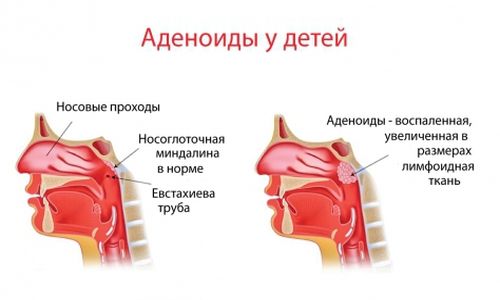 Схематическое изображение воспаления аденоидов у детей Схематическое изображение воспаления аденоидов у детей