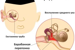 Схема отита среднего уха