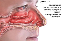 Вазомоторный ринит аллергический