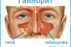 Острый гайморит - осложнение после вазомоторного ринита